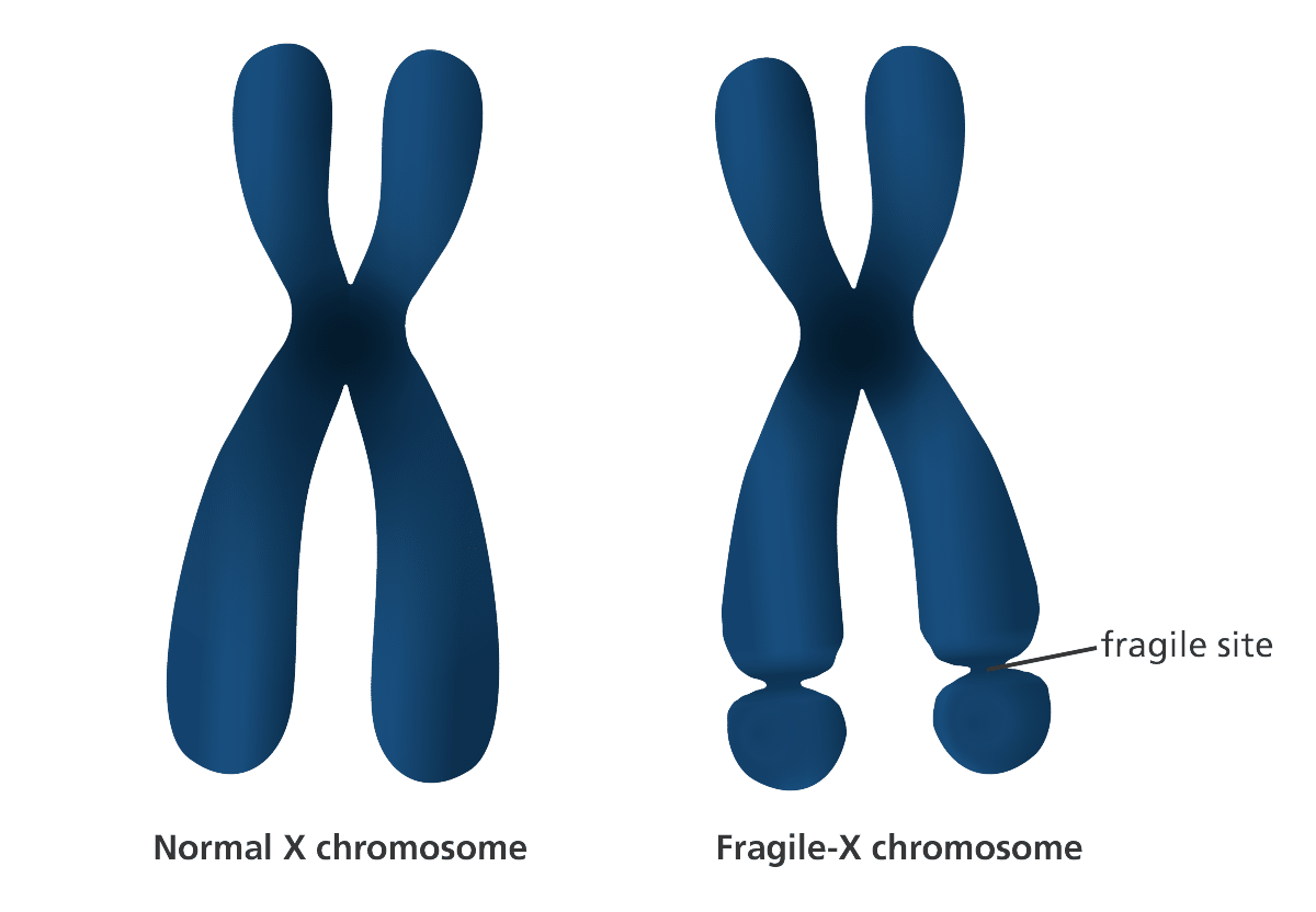 Fragile X Syndrome X chromasome